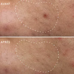 Deep Breakout Liquid Patch Anti-Imperfections