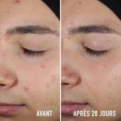 Soin Ciblé Anti-Imperfections